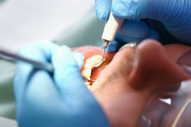 Best Emergency Tooth Extraction in South Euclid, OH